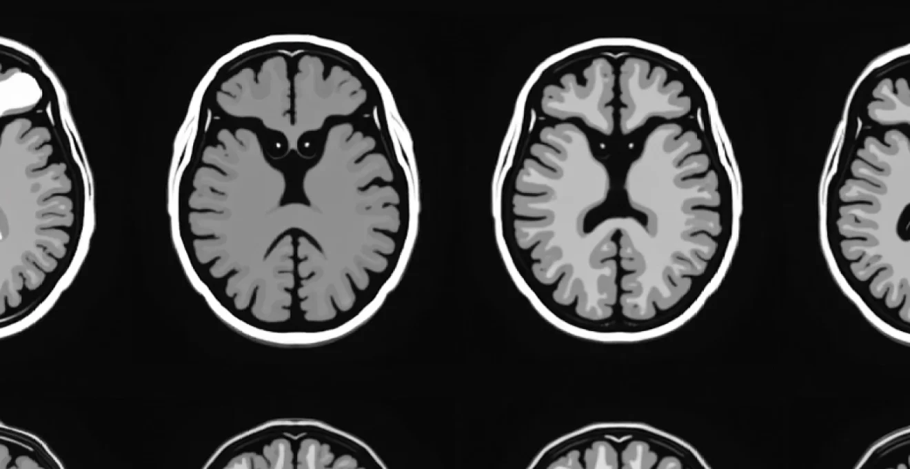 small-black-holes-on-brain-mri-interpretation