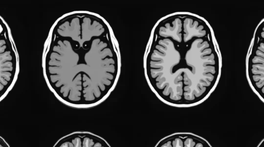 small-black-holes-on-brain-mri-interpretation